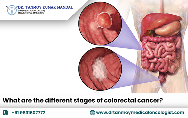 What are the different stages of colorectal cancer?