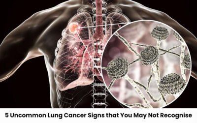 5 Uncommon Lung Cancer Signs That You May Not Recognise