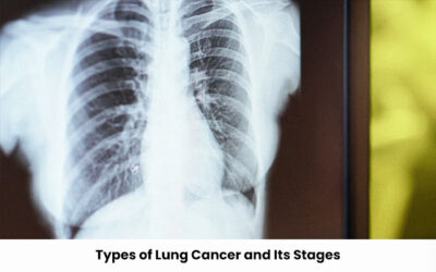 Types of Lung Cancer and Its Stages